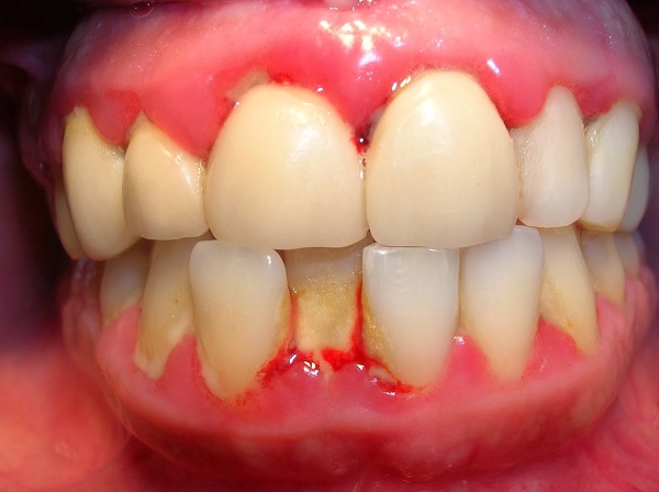 Nguyên nhân gây răng lung lay, rụng răng sớm Thái Nguyên